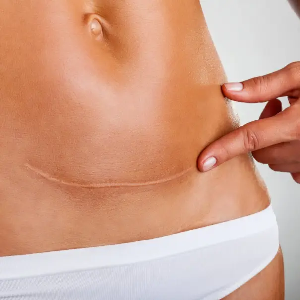 Cuppingbehandeling op litteken van keizersnede – herstel fascia en doorbloeding